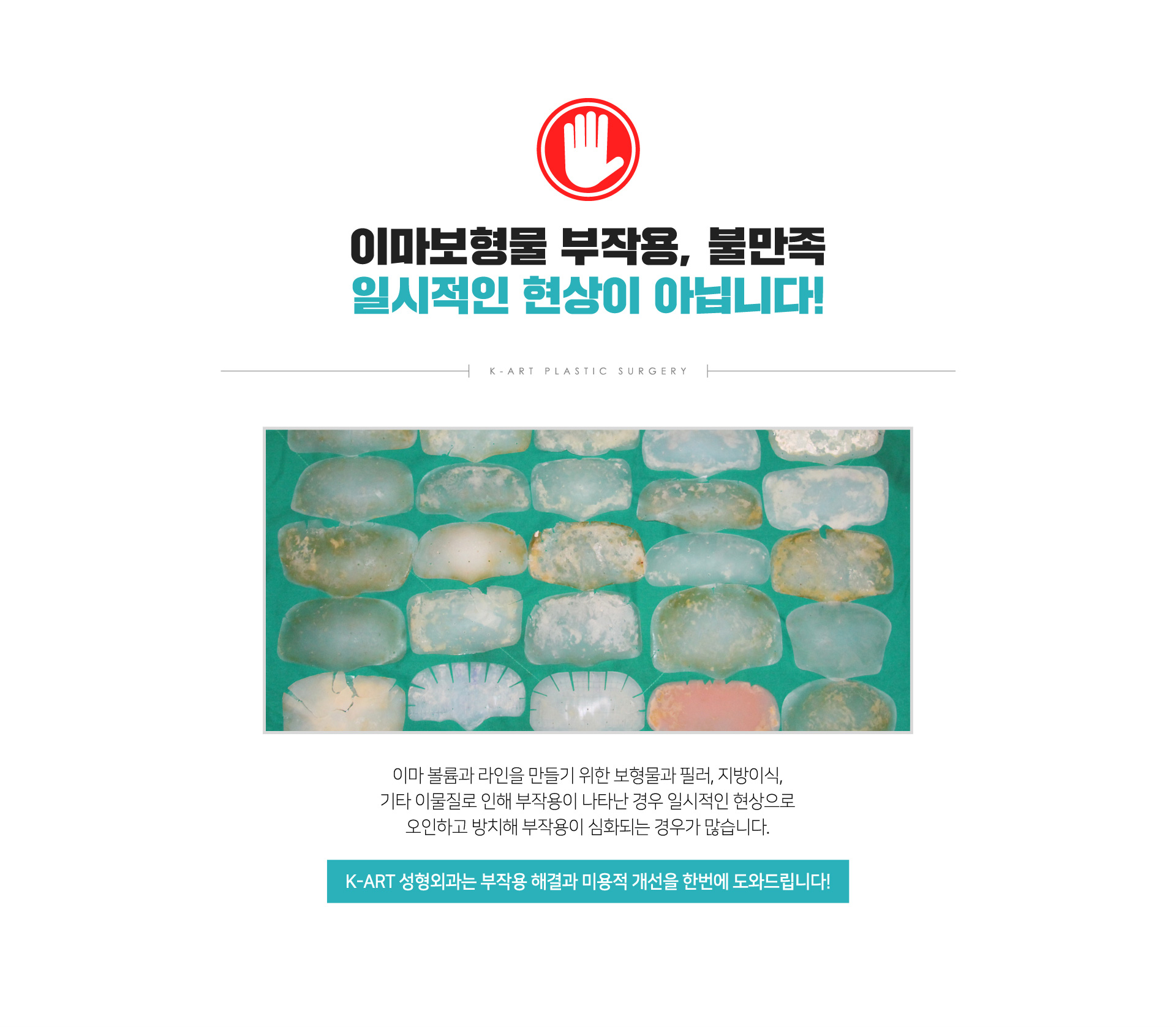 이마보형물 부작용, 불만족 일시적인 현상이 아닙니다!